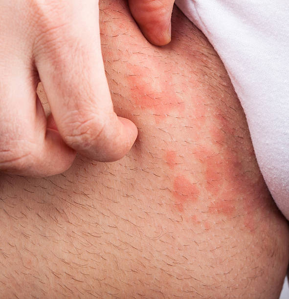 eczema leiste - allergologe stock-fotos und bilder