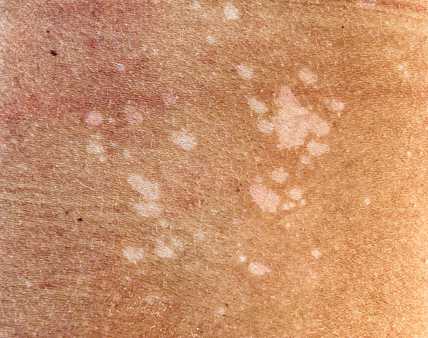 Skin Fungus, Tinea Versicolor Skin Fungus, Tinea Versicolor on the human back. Nikon D800e. Converted from RAW.  ringworm photos stock pictures, royalty-free photos & images