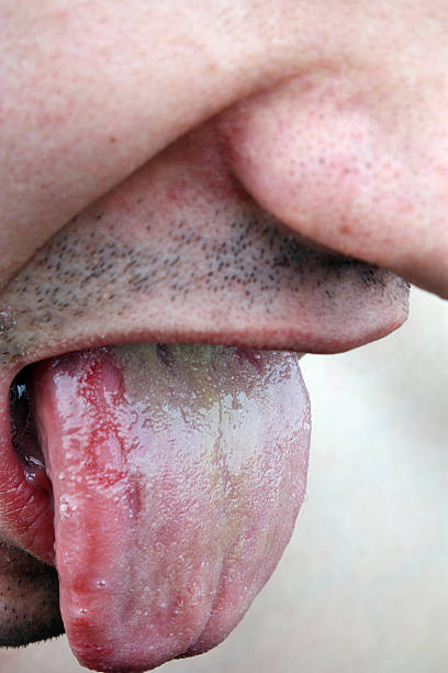 istock Bacterial infection disease tongue 467649063
