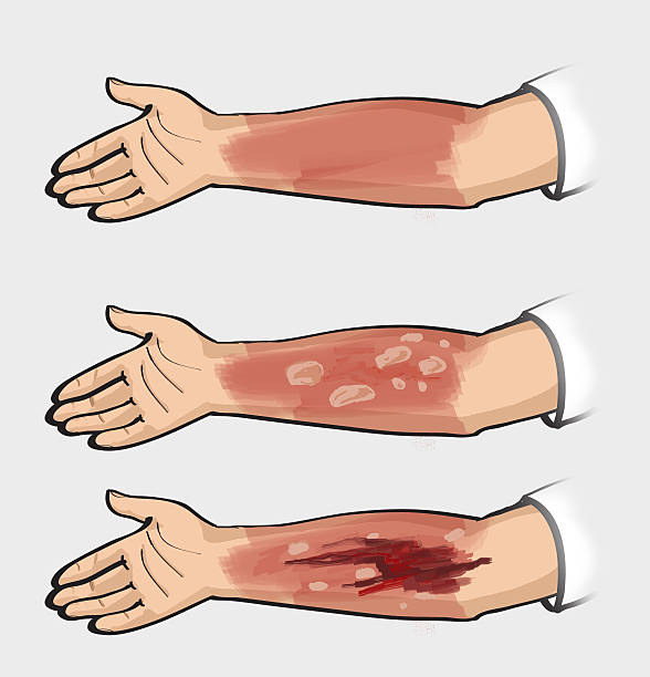 1,271 Skin Burn Illustrations & Clip Art - iStock | Red skin burn, Chemical  skin burn, Woman skin burn