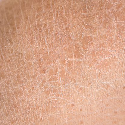 Sequedad de la piel (Ictiosis) detalle photo