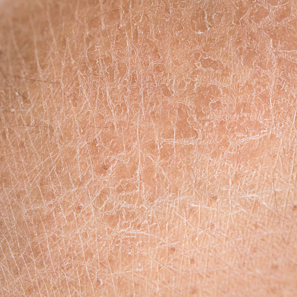 sequedad de la piel (ictiosis) detalle - tan skin fotografías e imágenes de stock