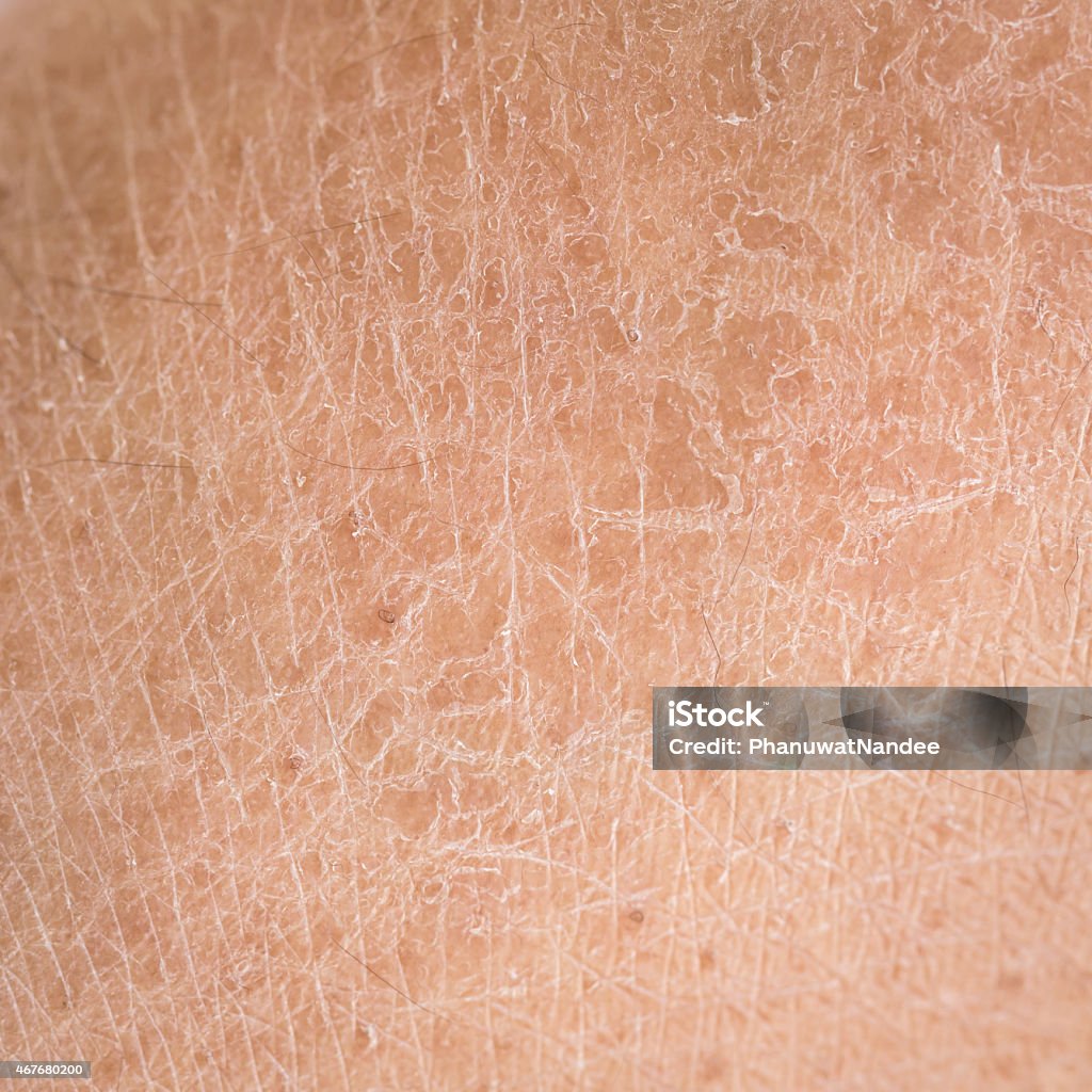 dry skin (ichthyosis) detail Macro dry skin (ichthyosis) detail Dry Stock Photo