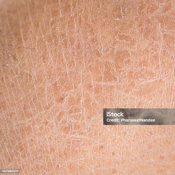 Dry Skin Detail Stock Photo - Download Image Now - Dry, Human Skin, Close-up