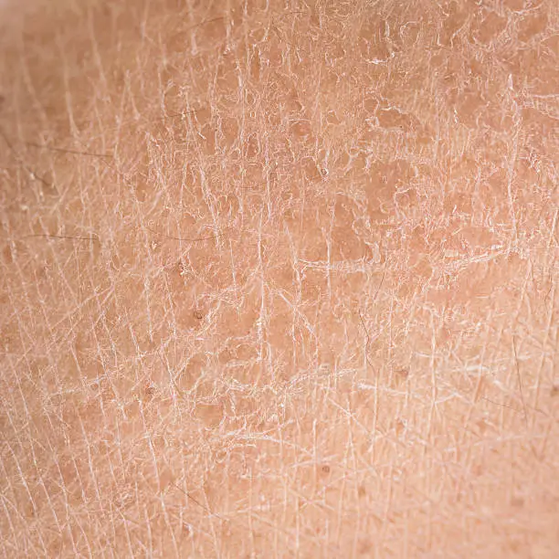 Photo of dry skin (ichthyosis) detail