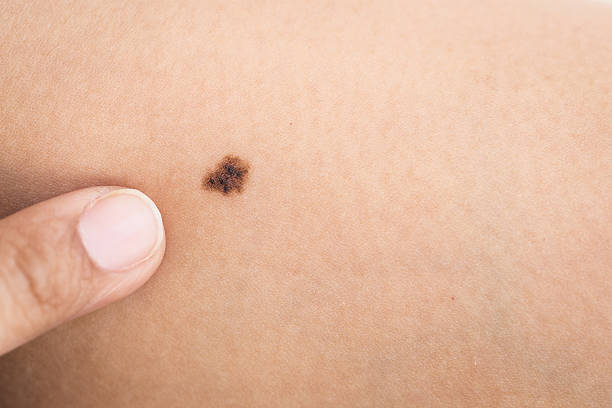 Birthmark on skin Macro black birthmark on skin mole stock pictures, royalty-free photos & images