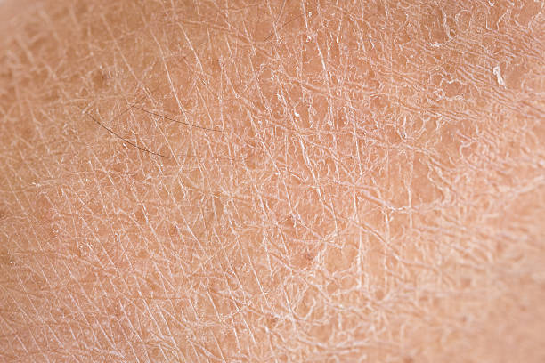istock dry skin (ichthyosis) detail 467684298