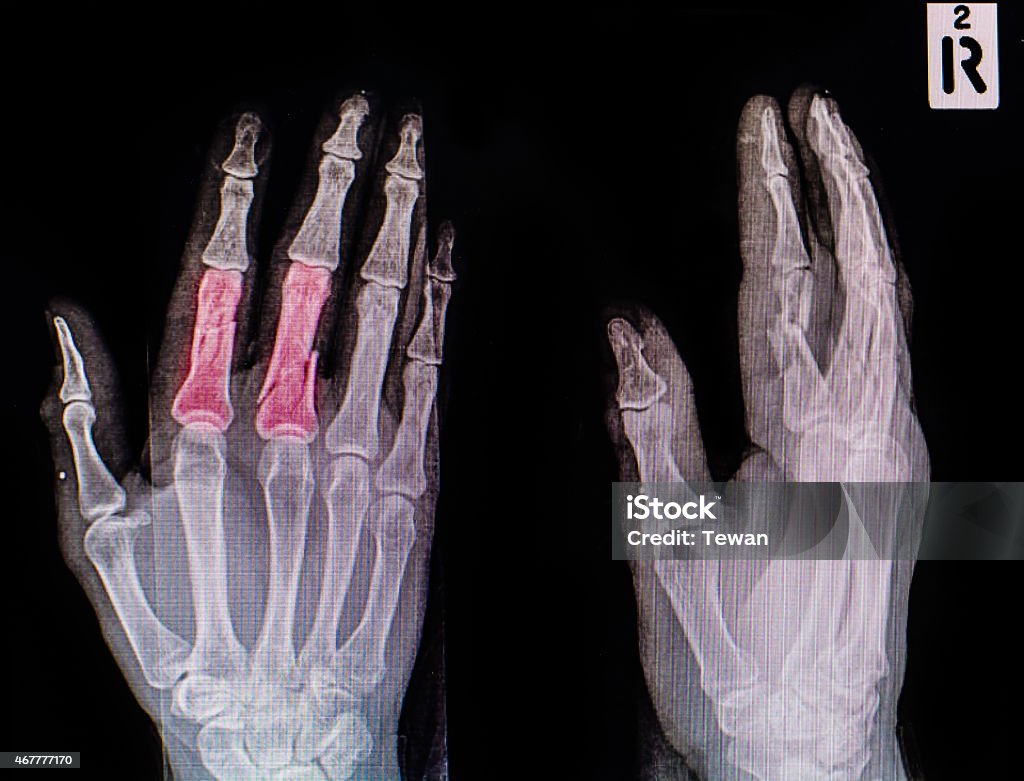 X-Ray Hand Index Finger Stock Photo