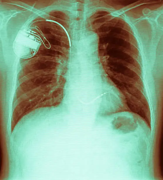 chest with the pacemaker on x-ray filmchest with the pacemaker on x-ray filmchest with the pacemaker on x-ray film