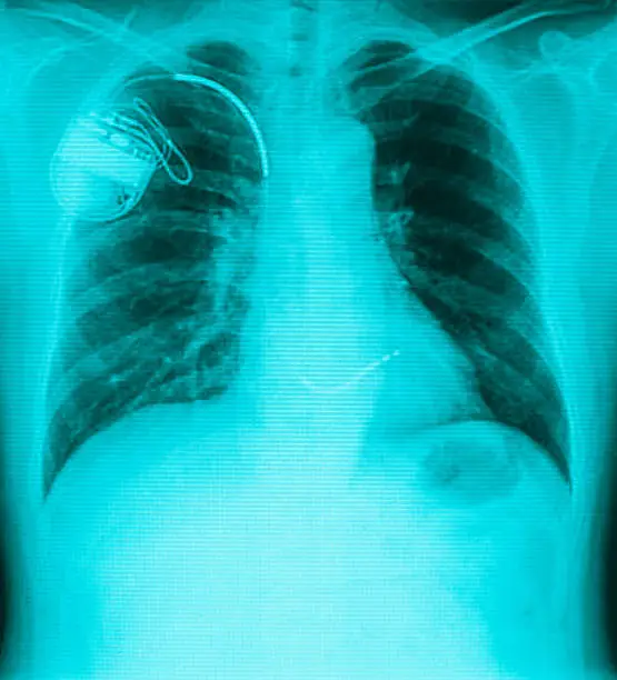 chest with the pacemaker on x-ray filmchest with the pacemaker on x-ray film