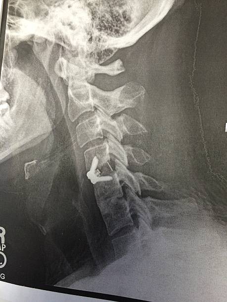 자궁경관 fusion, inplants 및 나사 - orthopedic equipment osteoporosis x ray human spine 뉴스 사진 이미지