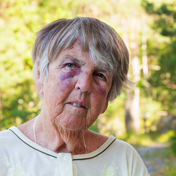 istock Scared and maltreated senior woman with big bruises 467905709