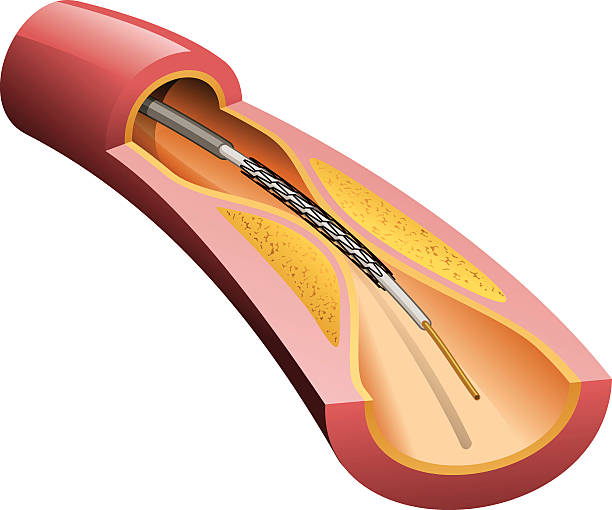 illustrations, cliparts, dessins animés et icônes de endoprothèse vasculaire dans l'artère - angioplasty