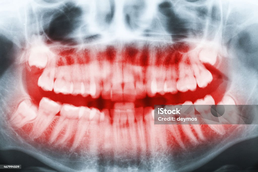 Closeup of x-ray - teeth and mouth image Close-up x-ray image of teeth and mouth with all four molars vertically impacted and still not grown and visible in the jaw bone. Filled cavities visible. Teeth shown in red. Anatomy Stock Photo