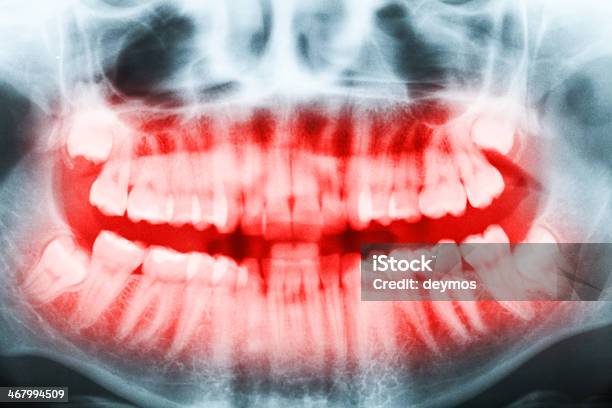 Closeup Of Xray Teeth And Mouth Image Stock Photo - Download Image Now - Anatomy, Bicuspid, Bizarre