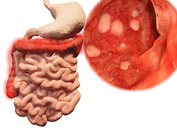 Occurrence of ulcerative colitis in the gastrointestinal trac stock photo
