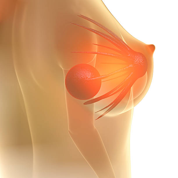 Breast Lump - 3d rendered illstration stock photo