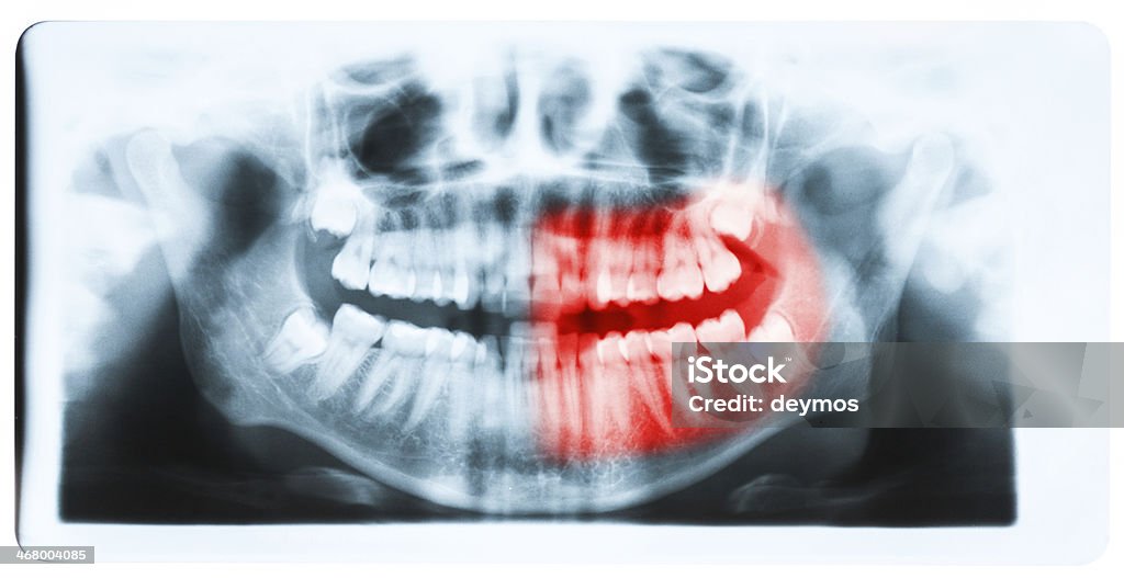 Closeup of x-ray - teeth and mouth image Panoramic x-ray image of teeth and mouth with all four molars vertically impacted and still not grown and visible in the jaw bone. Filled cavities visible. Teeth on the left part of the face (image right) shown red. Anatomy Stock Photo
