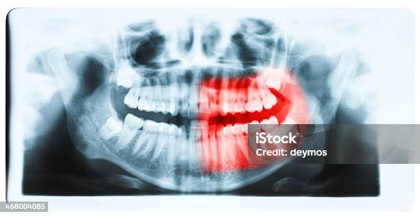 Closeup Of Xray Teeth And Mouth Image Stock Photo - Download Image Now - Anatomy, Bicuspid, Bizarre