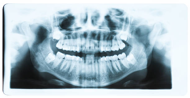 istock Closeup of x-ray - teeth and mouth image 468014805