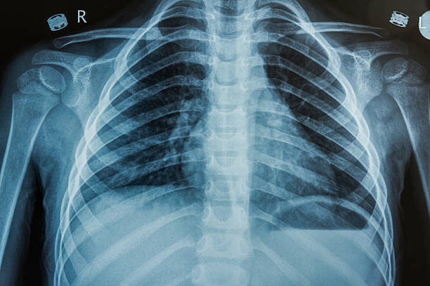 istock Child X-Ray Film 468020581