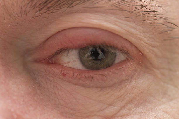 istock Ophtalmology - Eyelid Swelling closeup 468205346