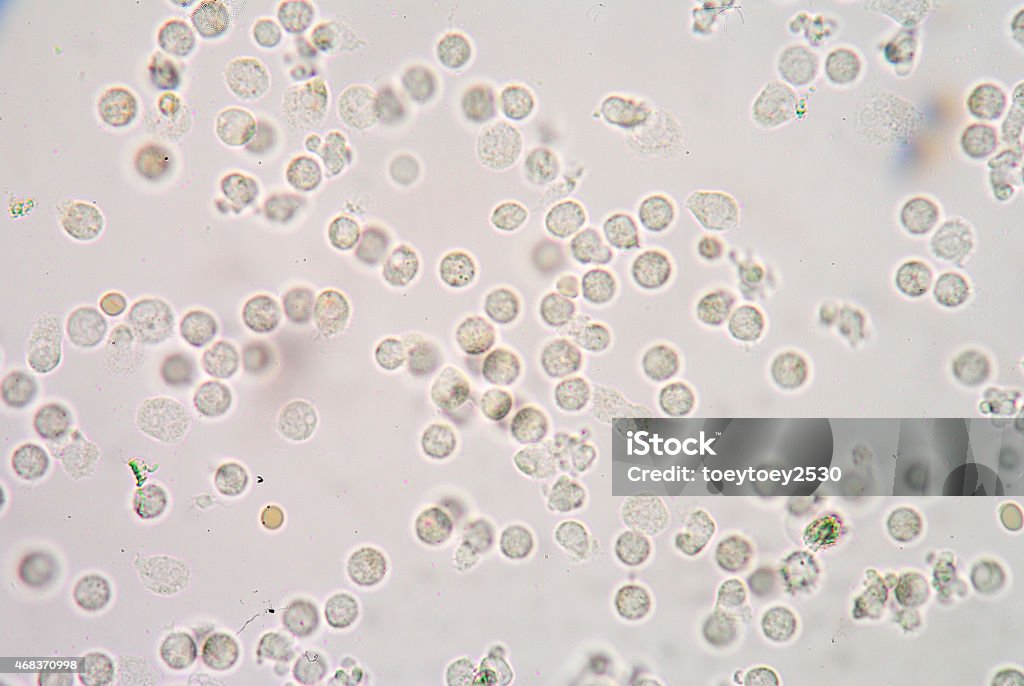 Leucocitos de los seres humanos, - Foto de stock de Leucemia granulocítica crónica libre de derechos