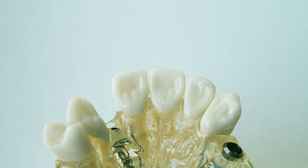 istock Dental Implant and Plastic Model 468423485