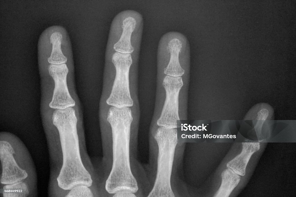 X - Ray Fingers Human fingers 2015 Stock Photo