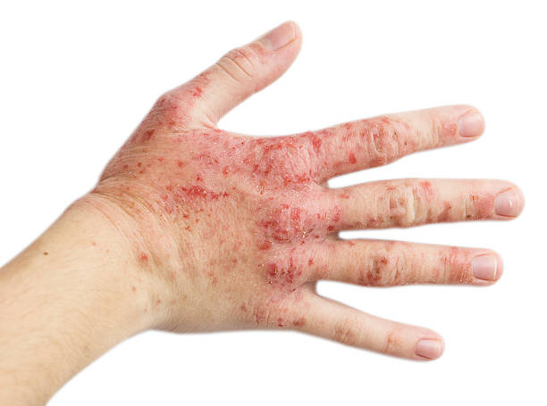 Uma mão direita de uma mulher com eczema nela O problema com muitas pessoas - eczema na mão. Fundo isolado dermatite mão fotos de stock, fotos e imagens livres de direitos