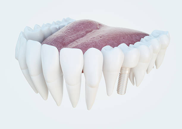 istock Dental implant 468495972