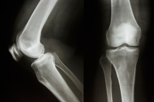 Film X-ray show normal knee joint(AP/Lateral)