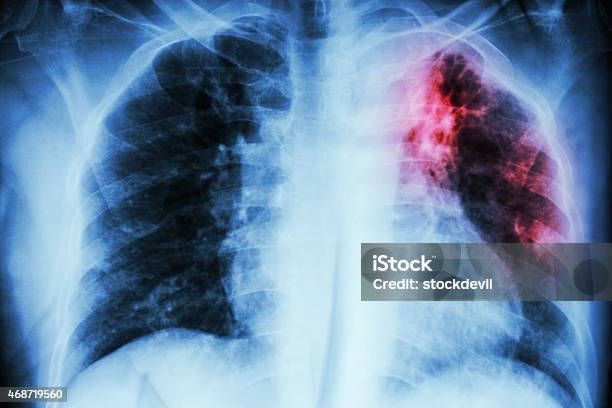 Pulmonary Tuberculosis Stock Photo - Download Image Now - Tuberculosis Bacterium, Fibrosis, X-ray Image