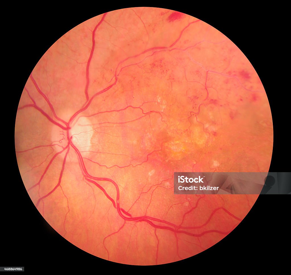 Medical Fundus photo of retinopathy hemmorhage Medical Fundus photo of retinal pathology, hemmorhages, vein occlusion, macular degeneration Retina Stock Photo