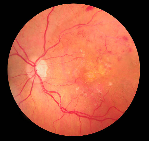 Medical Fundus photo of retinopathy hemmorhage Medical Fundus photo of retinal pathology, hemmorhages, vein occlusion, macular degeneration atrophy stock pictures, royalty-free photos & images