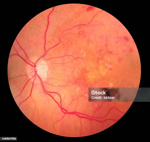 Medical Fundus Photo Of Retinopathy Hemmorhage Stock Photo - Download Image Now - Retina, Fundus, Photography