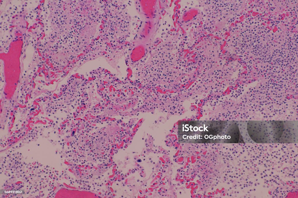 Micrograph of human lung tissue with pneumonia High scale magnification micrograph of human lung tissue with pneumonia. Pneumonia is an inflammatory condition of the lung affecting primarily the microscopic air sacs known as alveoli. It is usually caused by infection with viruses or bacteria and less commonly other microorganisms, certain drugs and other conditions such as autoimmune diseases. broncopneumonia,lobar pneumonia, baterial pneumonia,aveolar acute inflammatory exodate Inflammation Stock Photo