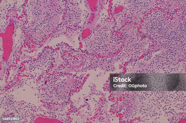 Micrograph Of Human Lung Tissue With Pneumonia Stock Photo - Download Image Now - Inflammation, Backgrounds, Biological Cell