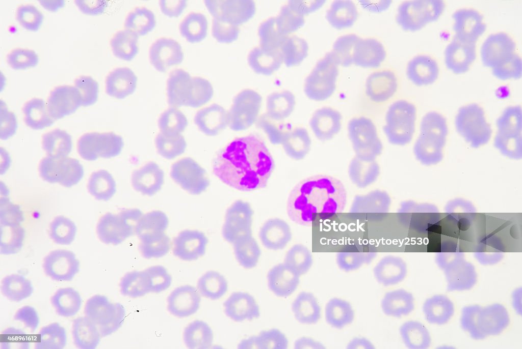 White blood cells of a human, White blood cells of a human, photomicrograph panorama as seen under the microscope, 1000x zoom. Chronic Granulocytic Leukemia Stock Photo