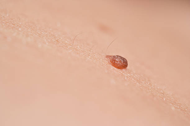 istock Suspicious looking mole or melanoma on pale skin 468996200