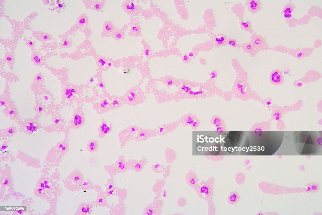 White blood cells of a human, White blood cells of a human, photomicrograph panorama as seen under the microscope Chronic Granulocytic Leukemia Stock Photo