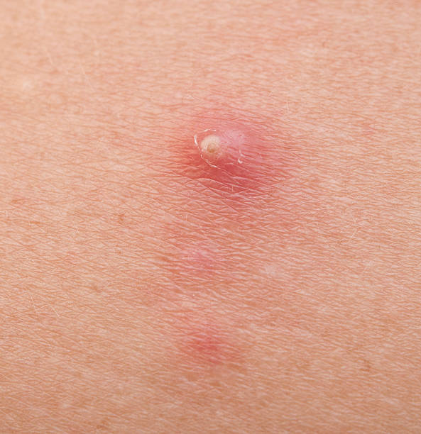 istock pimple extreme on human skin. macro 469110375