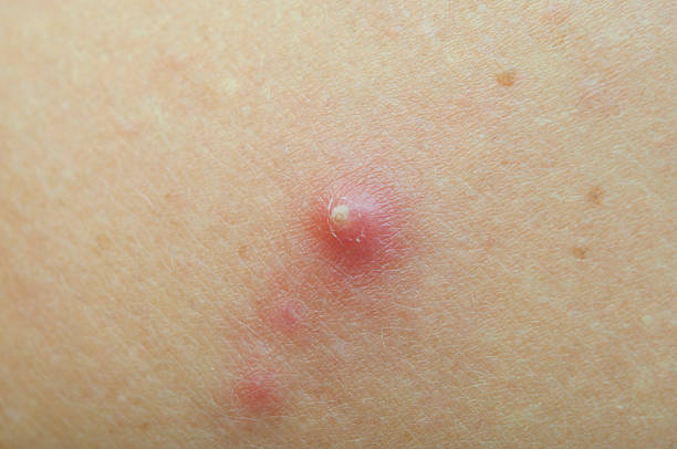 istock pimple extreme on human skin. macro 469111411