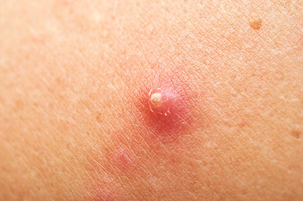 pimple extreme on human skin. macro