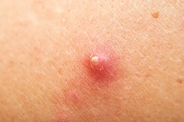pimple extreme on human skin. macro