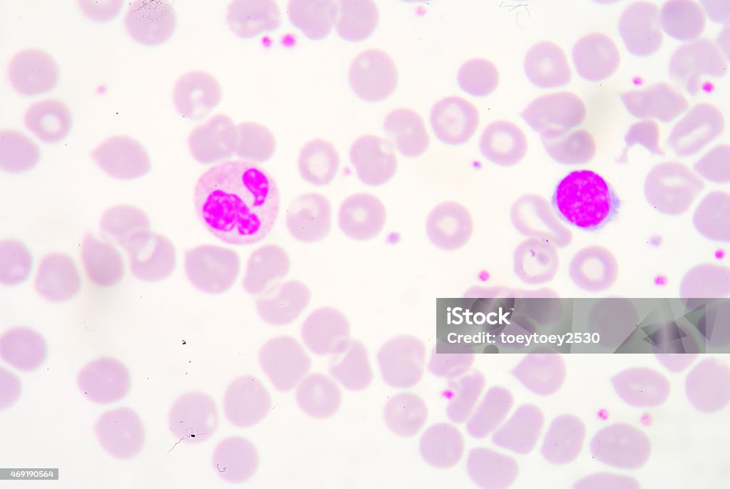 White blood cells of a human. White blood cells of a human, photomicrograph panorama as seen under the microscope, 1000x zoom. Chronic Granulocytic Leukemia Stock Photo