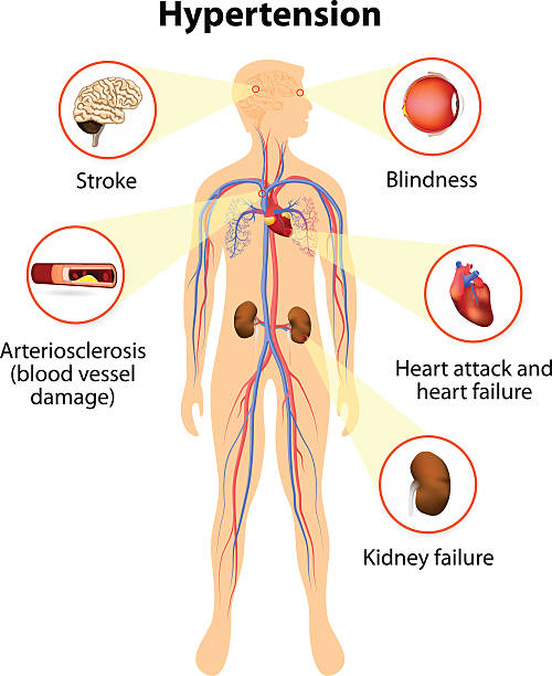 damage from high blood pressure damage from high blood pressure. hypertension increases risk of heart attack, stroke, and kidney failure. clogged artery stock illustrations