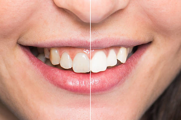 istock Teeth After and Before Whitening - Dental Care 469537472