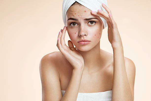 istock Girl squeezing her pimples, removing pimple from her face 469590984