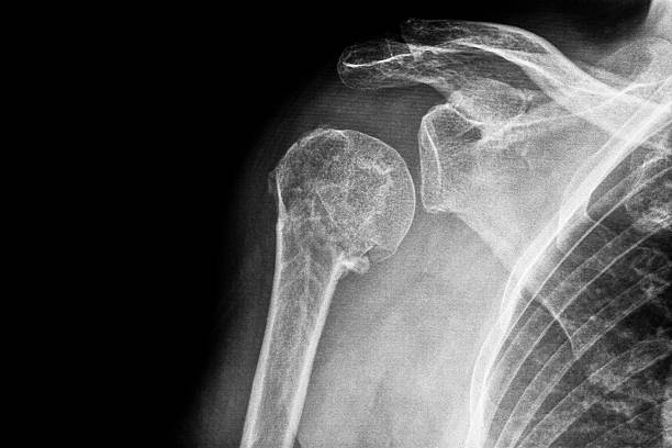 x-ray z złamanie z górnej części ramienia - humerus zdjęcia i obrazy z banku zdjęć